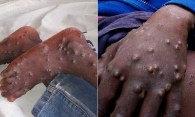 Man Tested Postive For Monkeypox in Singapore, 23 People Quarantined For 21 Days - WORLD OF BUZZ