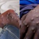 Man Tested Postive For Monkeypox in Singapore, 23 People Quarantined For 21 Days - WORLD OF BUZZ