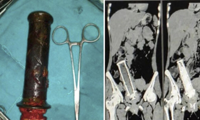 Drunk Husband Forcefully Inserts Motorcycle Handle - WORLD OF BUZZ