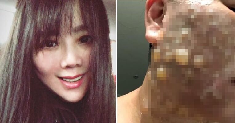 Woman Badly Disfigured & Scarred After Suffering Second-Degree Burns From Facelift - WORLD OF BUZZ 4