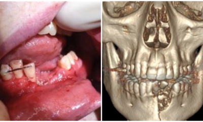 Beware: Vape Device Shatters 17-year-old's Jaw and Teeth After It Explodes in His Mouth - WORLD OF BUZZ