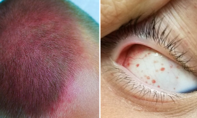 Boy Left With Bruised Head & Burst Eye Blood Vessels After Violently Spinning On Swings - WORLD OF BUZZ