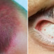 Boy Left With Bruised Head & Burst Eye Blood Vessels After Violently Spinning On Swings - WORLD OF BUZZ