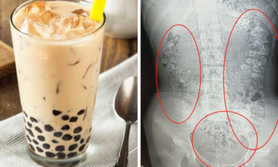 Doctors Shocked to Discover 14yo Girl Has Hundreds of Bubble Tea Pearls Lining Her Stomach - WORLD OF BUZZ 1