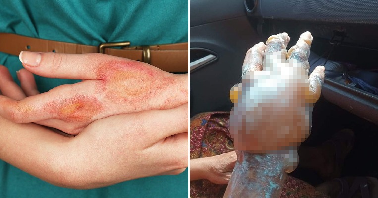 Malaysian Doctor Warns That Using Home Remedies Such as Toothpaste on Burns Is a Seriously Bad Idea - WORLD OF BUZZ