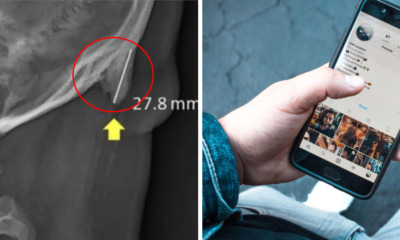 Young People Are Growing Horns on The Back of Their Skulls, & Our Phones Might Be to Blame - WORLD OF BUZZ