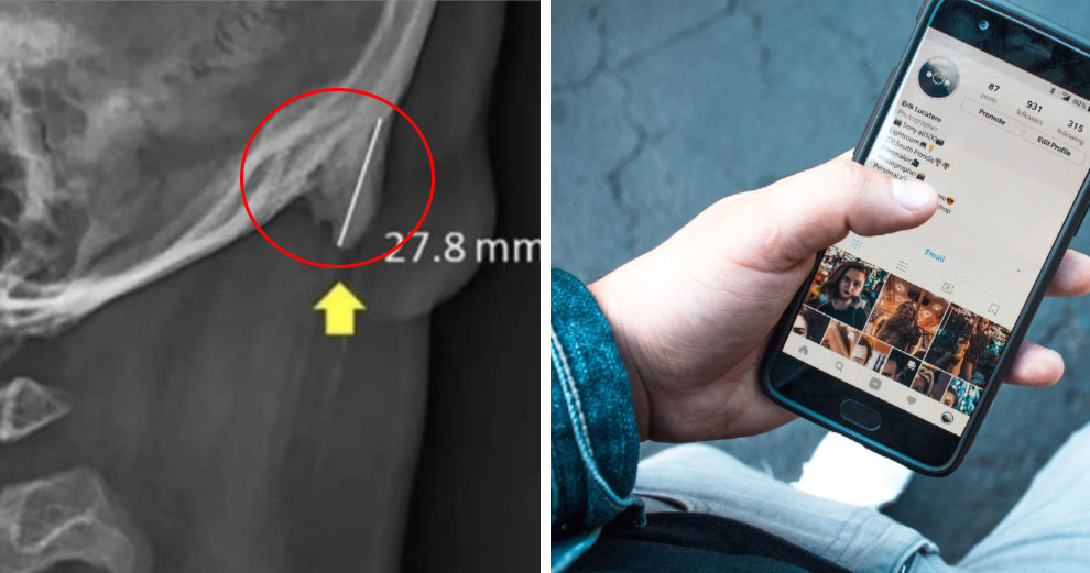 Young People Are Growing Horns on The Back of Their Skulls, & Our Phones Might Be to Blame - WORLD OF BUZZ