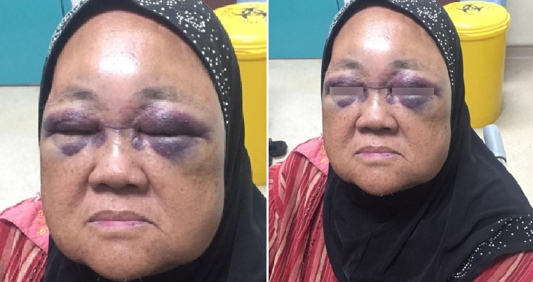 69yo Malaysian Risks Being Blind After Grandson Punches Her Eyes When His Baby Cried - WORLD OF BUZZ 2