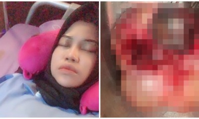 Alor Setar Woman Developed Two Huge Ovarian Cysts Due to Eating Too Much Fast Food - WORLD OF BUZZ