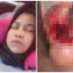 Alor Setar Woman Developed Two Huge Ovarian Cysts Due to Eating Too Much Fast Food - WORLD OF BUZZ