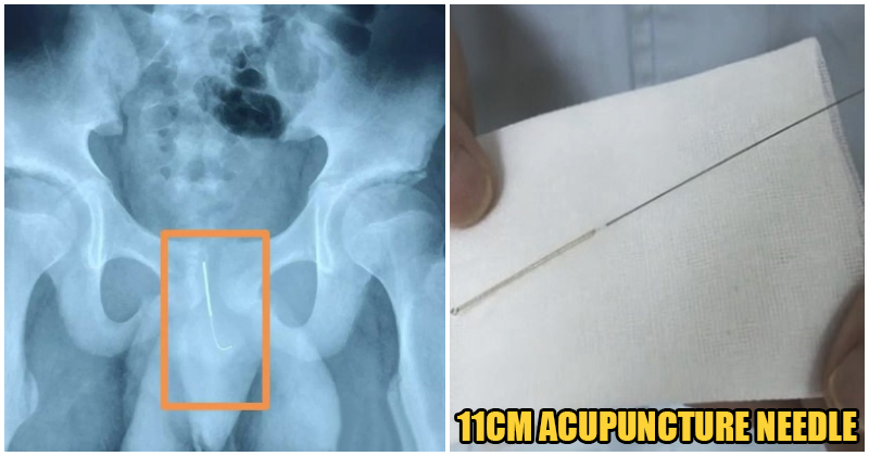 Boy Inserts 11CM Needle Into Urethra In Order To Stay Awake To Complete His Assignments - WORLD OF BUZZ 7