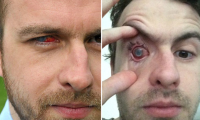 Man's Right Eye Goes - WORLD OF BUZZ