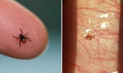 Electrical Worker Who Always Uses Insect Repellent Finds A Tick Inside His Cornea - WORLD OF BUZZ 3