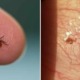 Electrical Worker Who Always Uses Insect Repellent Finds A Tick Inside His Cornea - WORLD OF BUZZ 3