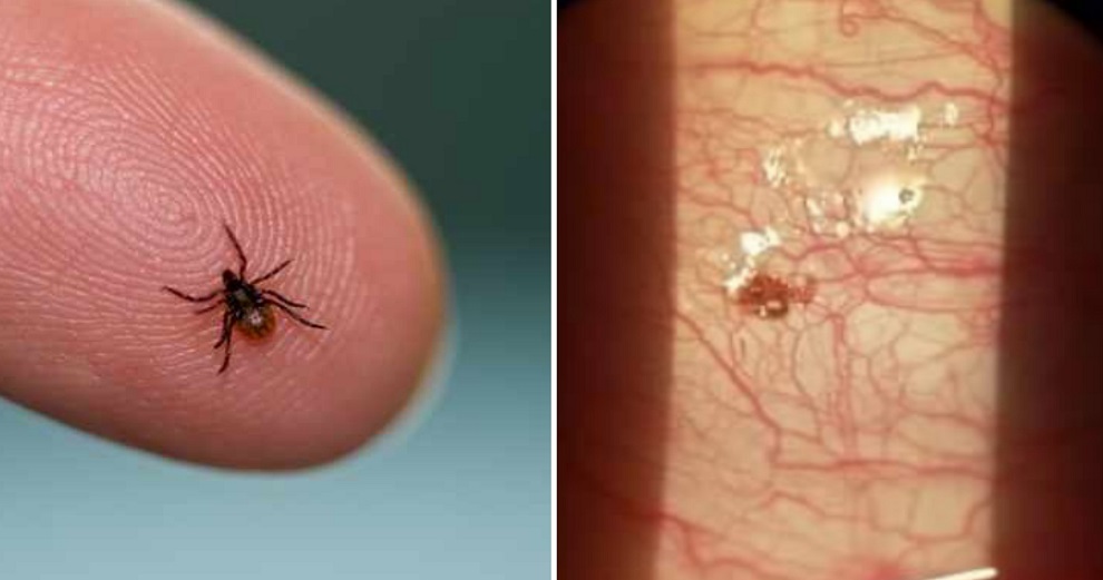 Electrical Worker Who Always Uses Insect Repellent Finds A Tick Inside His Cornea - WORLD OF BUZZ 3