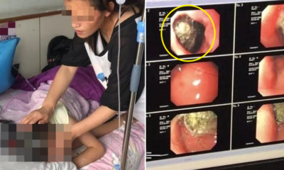 9yo Found to Have 18cm Diameter Hairball in Stomach After Mother Notices Her Balding - WORLD OF BUZZ