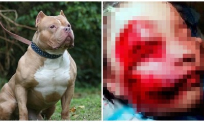 Johor Girl Hospitalised After Being Attacked By Neighbour's Mixed Breed Pitbull - WORLD OF BUZZ