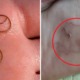 Malaysian Woman Gets Worm Infection in Her Foot After Family Vacation in Port Dickson - WORLD OF BUZZ