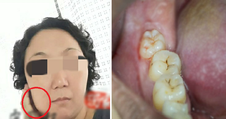M'sian Mother Of 2 Throws Up Black Liquid, Passes Away 5 Days After Wisdom Tooth Extraction - WORLD OF BUZZ 1