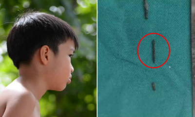 8yo Boy Shocked to Find 3 Broken Pieces of Sewing Needle in His Neck, No Clue How it Got There - WORLD OF BUZZ