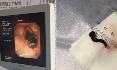Woman Coughs Out Blood, Doctor Finds 3cm Leech In Her Throat - WORLD OF BUZZ 1
