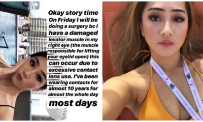 Woman Undergoes Eye Surgery Due to Frequent Usage of Contact Lens - WORLD OF BUZZ