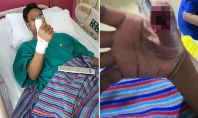 Young Man's Thumb Got Swollen & Infected After He Unknowingly Cut It On Cracked Screen Protector - WORLD OF BUZZ 2