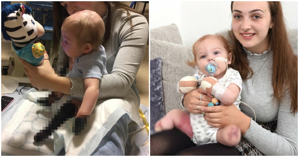 11-Month-Old Develops Sepsis From Throat Infection, All Limbs Amputated - WORLD OF BUZZ