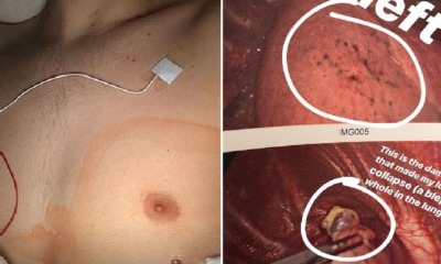 18yo Who Has Been Vaping Juul For 18 Months Undergoes Emergency Surgery For Collapsed Lung - WORLD OF BUZZ 4