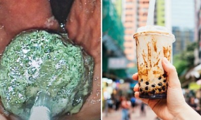 20yo Man Drinks Bubble Tea 3 Times a Day, Ends Up With Severe Tapioca Blockage in Intestines - WORLD OF BUZZ 2