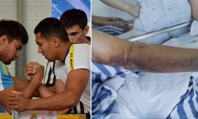 21yo College Student Fractures Arm & Loses Control of It After Arm-Wrestling With Friend - WORLD OF BUZZ 1