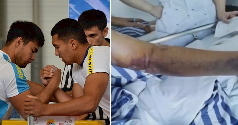 21yo College Student Fractures Arm & Loses Control of It After Arm-Wrestling With Friend - WORLD OF BUZZ 1