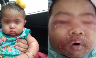 5-Month-Old Baby Gets Swollen & Painful Face After Contracting Severe Skin Infection From Being Held By Others - WORLD OF BUZZ