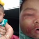 5-Month-Old Baby Gets Swollen & Painful Face After Contracting Severe Skin Infection From Being Held By Others - WORLD OF BUZZ