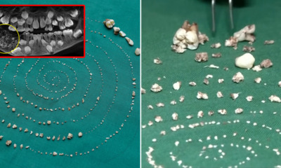 Doctors Find 526 Teeth in Sac-Like Growth in 7yo Boy's Mouth After He Complained About Pain in Jaw - WORLD OF BUZZ