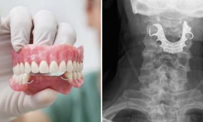 Elderly Man's Dentures Got Stuck in Throat During Surgery, Doctors Only Noticed it 8 Days Later - WORLD OF BUZZ 3
