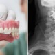 Elderly Man's Dentures Got Stuck in Throat During Surgery, Doctors Only Noticed it 8 Days Later - WORLD OF BUZZ 3