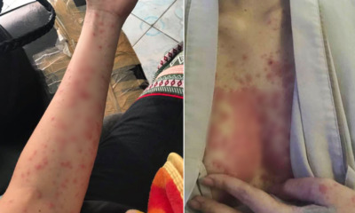 Woman Develops Severe Rash Due to an Imbalanced Immune Sys - WORLD OF BUZZ