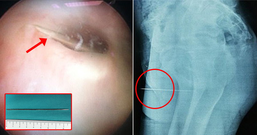 14yo Boy Couldn't Urinate for 3 Days After Shoving 9cm Needle Up His Penis for Sexual Pleasure - WORLD OF BUZZ