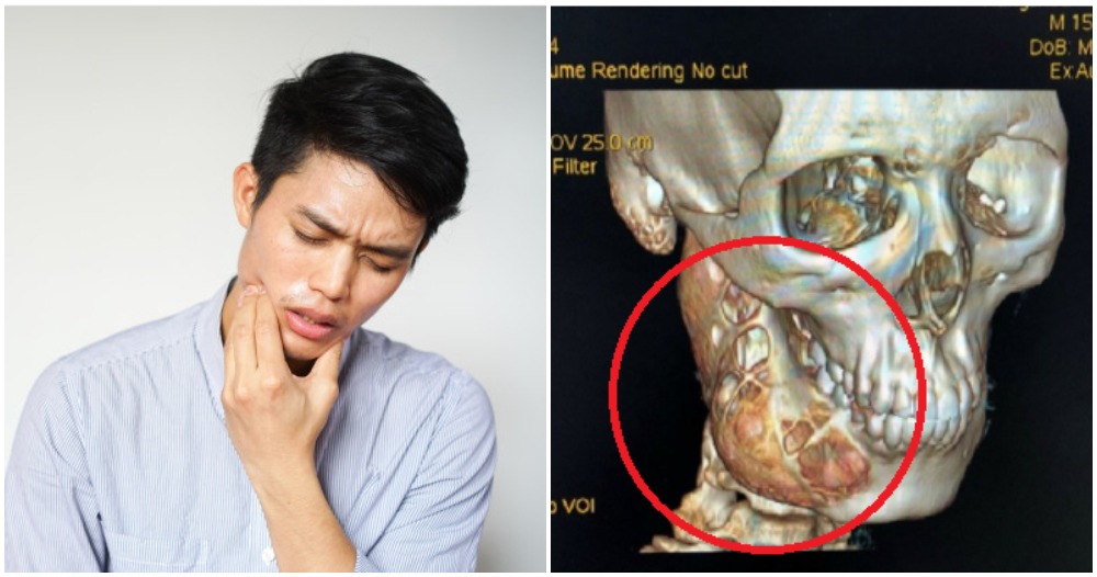 15yo Teen Has Toothache For Over A Year, Loses 20% of Jaw As It Is A Form of Cancer - WORLD OF BUZZ 2