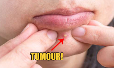 51yo Man Pops 'Pimple' On Forehead, Then Discovers It's Actually A Cancerous Tumor - WORLD OF BUZZ