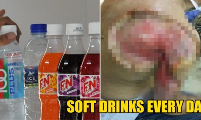 56yo M'sian Man Drank Soft Drinks Every Day, Gets Blistering Skin Infection & Almost Loses His Arm - WORLD OF BUZZ