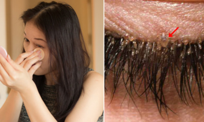 32yo Woman Did Not Remove Makeup Properly Found Mites in Her Eyelashes After Having Itchy & Dry Eyes - WORLD OF BUZZ