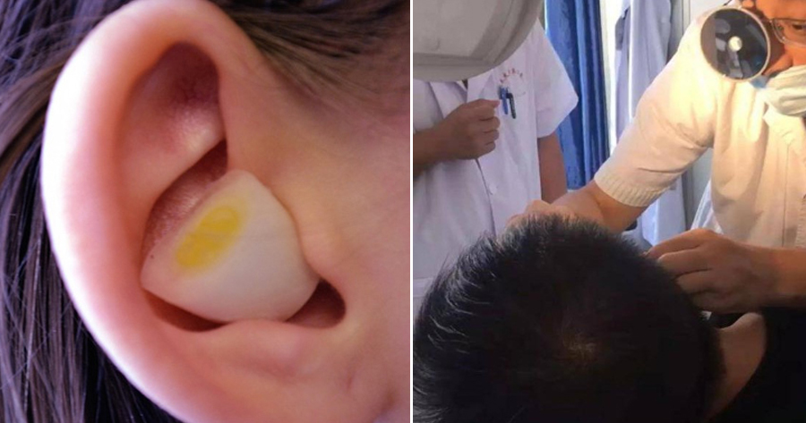 Man Couldn't Sleep at Night so He Stuffs Raw Garlic Into Ear, Gets Stuck As It Was Too Deep - WORLD OF BUZZ