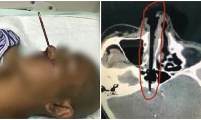 Man Picks Nose With Chopstick, Winds Up Puncturing His Nasal Cavity Instead - WORLD OF BUZZ