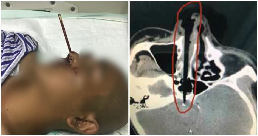 Man Picks Nose With Chopstick, Winds Up Puncturing His Nasal Cavity Instead - WORLD OF BUZZ
