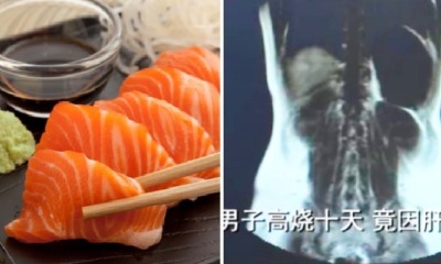 Man's Liver Gets Infected with Parasitic Worms After He Ate Raw Seafood for 3 Years - WORLD OF BUZZ 2