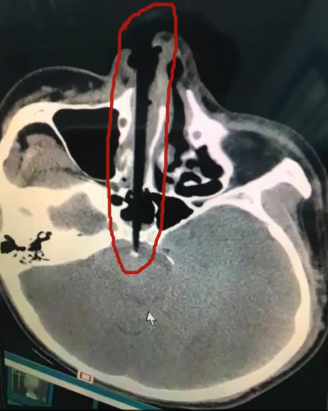 Nose3