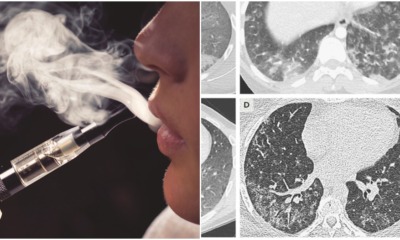 More Tragedies from Vaping Illness; 7 deaths and 530 cases reported - WORLD OF BUZZ