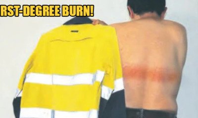 40yo Suffers First-Degree Burns On His Back After Reflective Strip on Shirt Becomes Too Hot - WORLD OF BUZZ